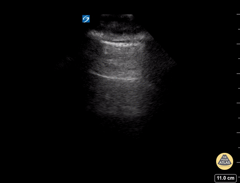 A - Lines - Normal Lung
