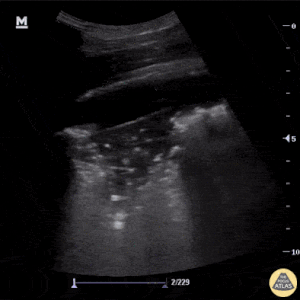 Classic Findings in Pneumonia